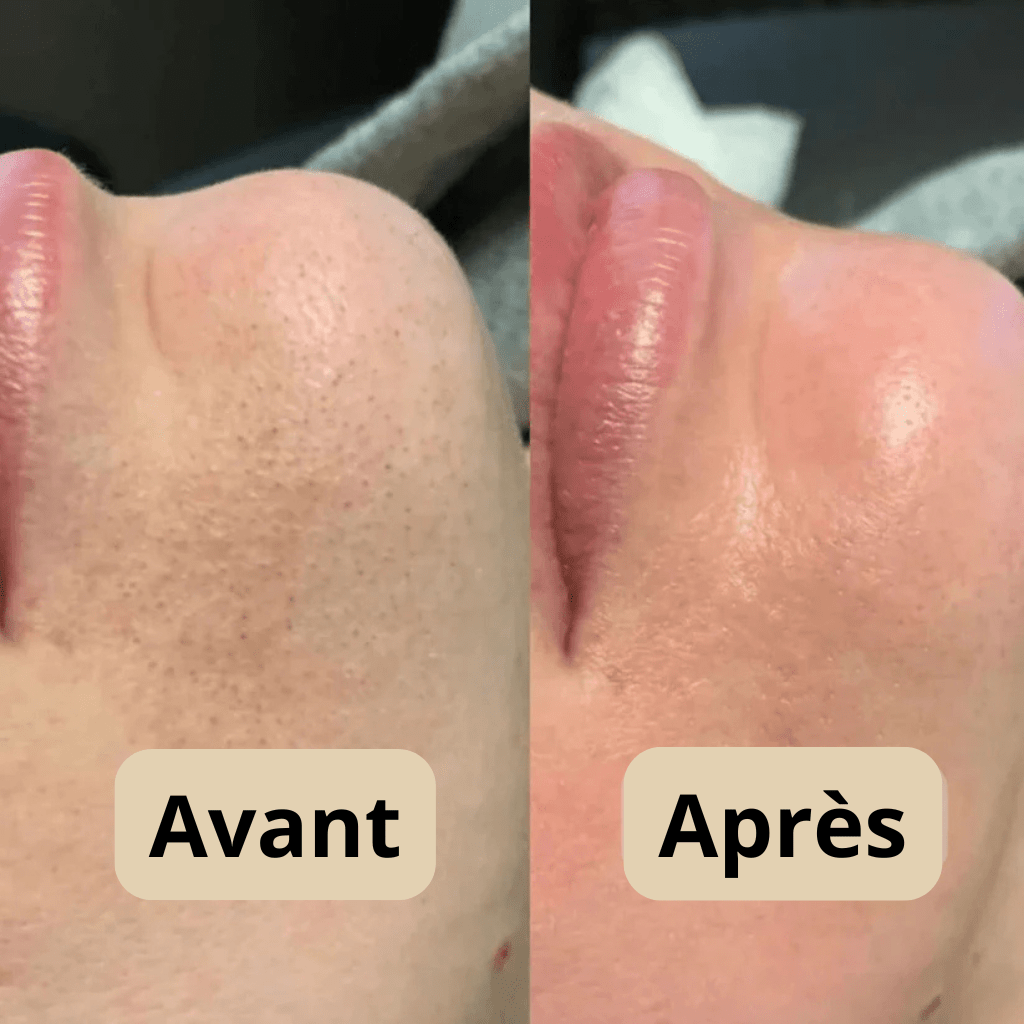 Peel Shot — Exfoliant